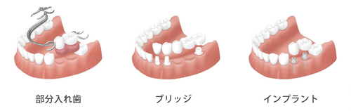 implant01.jpg