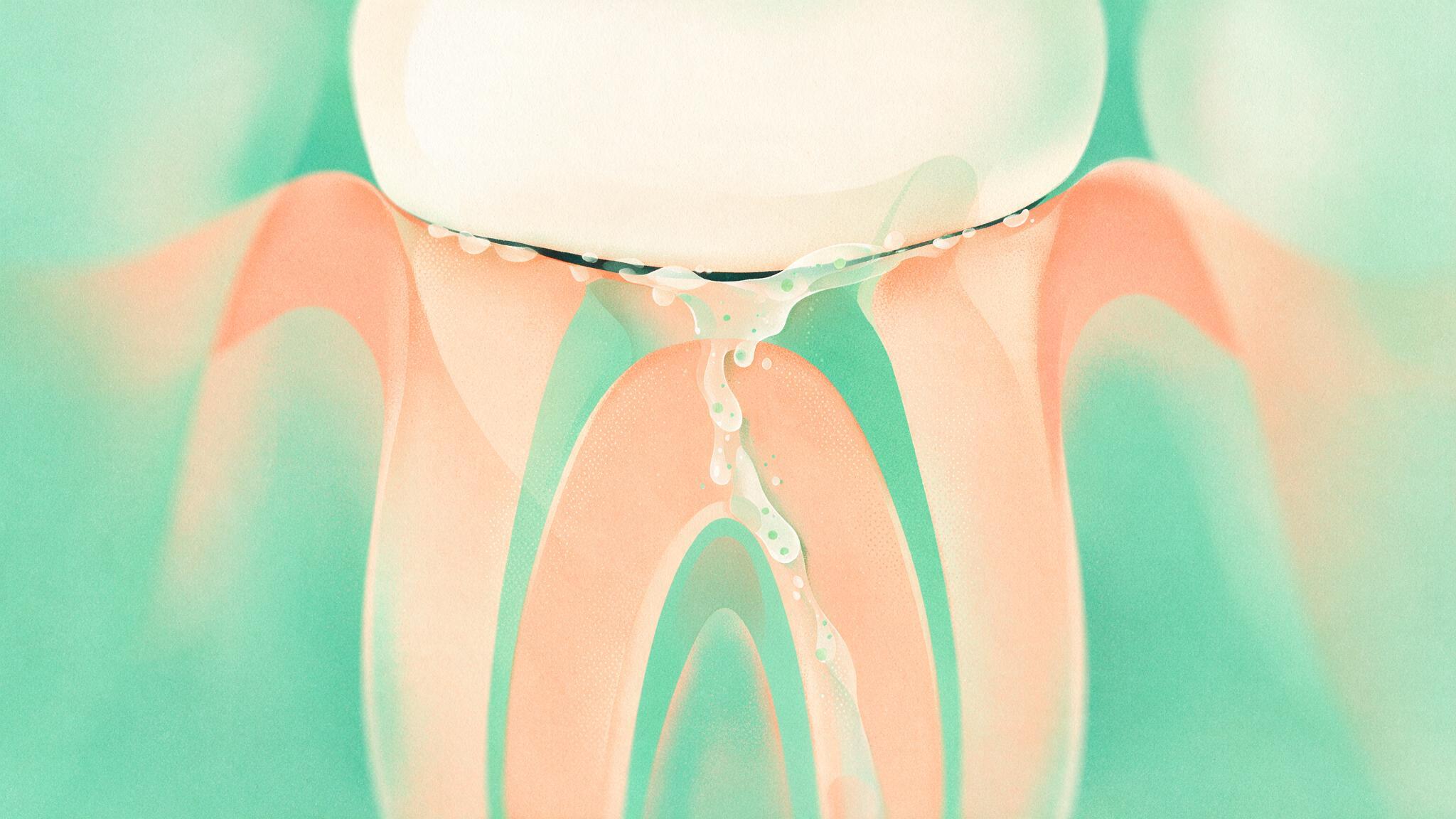 被せ物の縁の隙間から唾液と細菌が根管内へ染み込んでいく断面イラスト